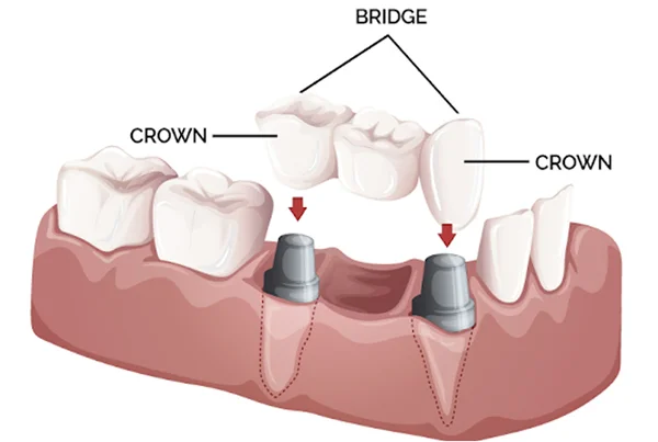 Crown and Bridges